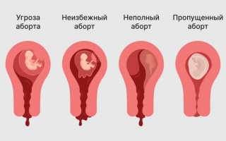 Что такое и как проявляется имплантационное кровотечение?