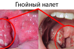 Гнойный налет на миндалинах при фолликулярной ангине Гнойный налет на миндалинах при фолликулярной ангине