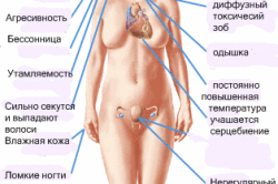 Симптомы гипертериоза Симптомы гипертериоза