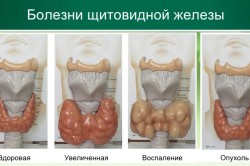 Болезни щитовидной железы Болезни щитовидной железы