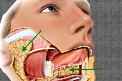Опухоль слюнной железы Опухоль слюнной железы
