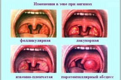 Виды язвенной ангины Виды язвенной ангины