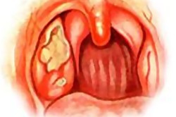 Язвенная ангина Венсана Язвенная ангина Венсана